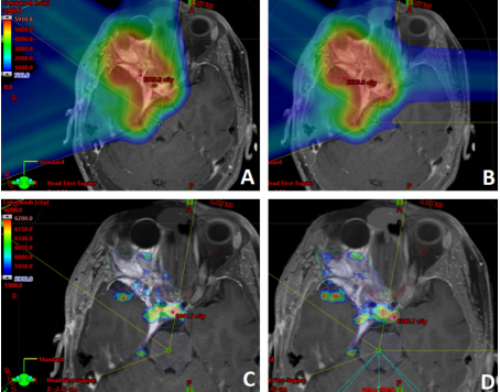 Jason Sheehan: Improving visual outcomes with the latest SRS and particle therapy approaches for skull-based tumors