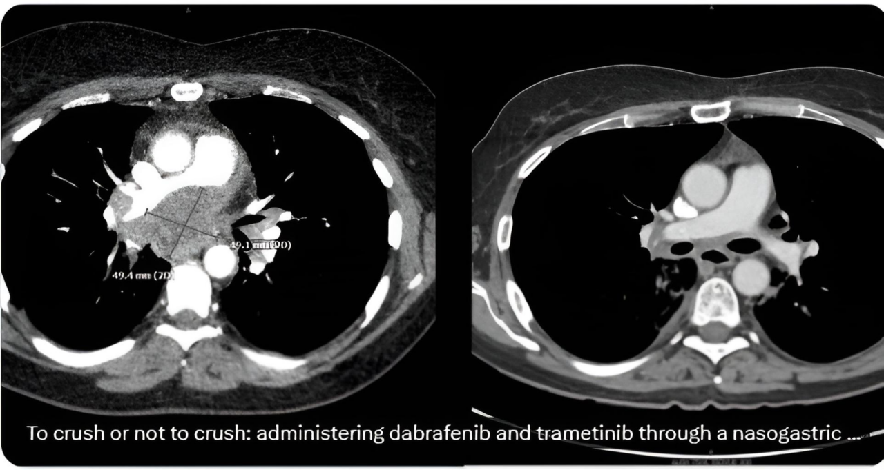 Stephen V Liu: Need more data on PKs with crushing TKI pills
