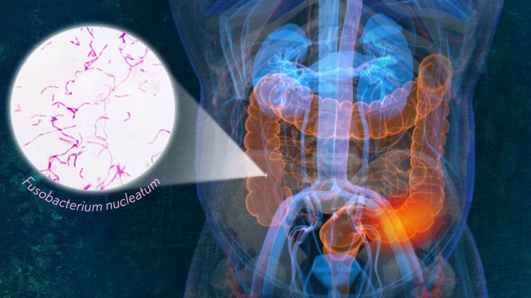 Monica Bertagnolli: A subtype of a microbe commonly found in the mouth has been linked to the progression of colorectal cancer tumors