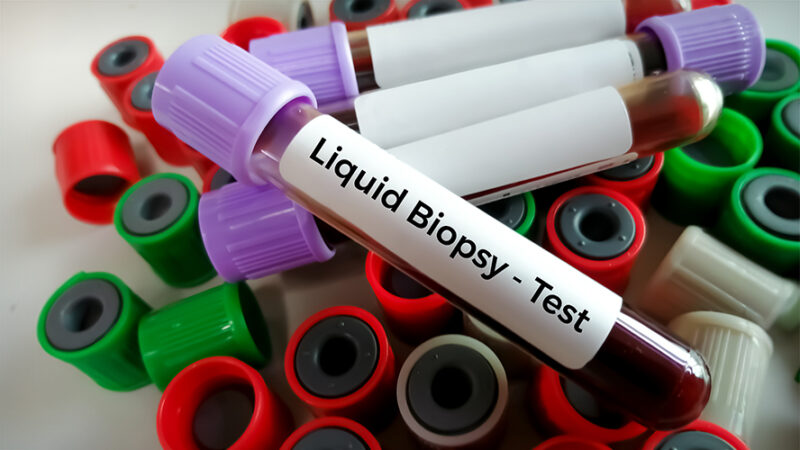 UHN Research – Can a blood sample be used to predict patient outcomes to cancer immunotherapy drug pembrolizumab?