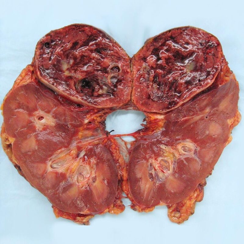 Pheochromocytoma