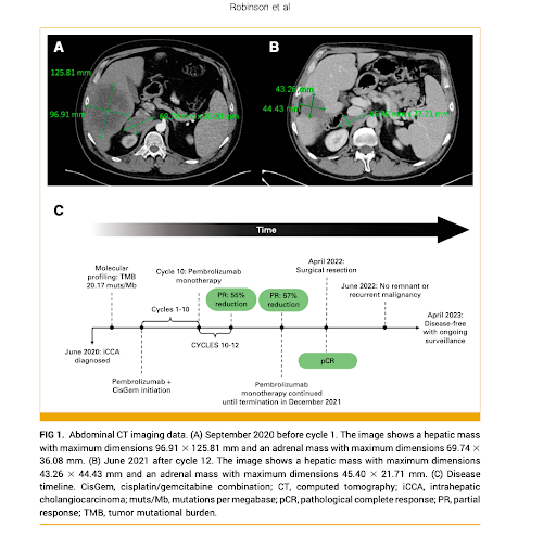 Intrahepatic Cholangiocarcinoma