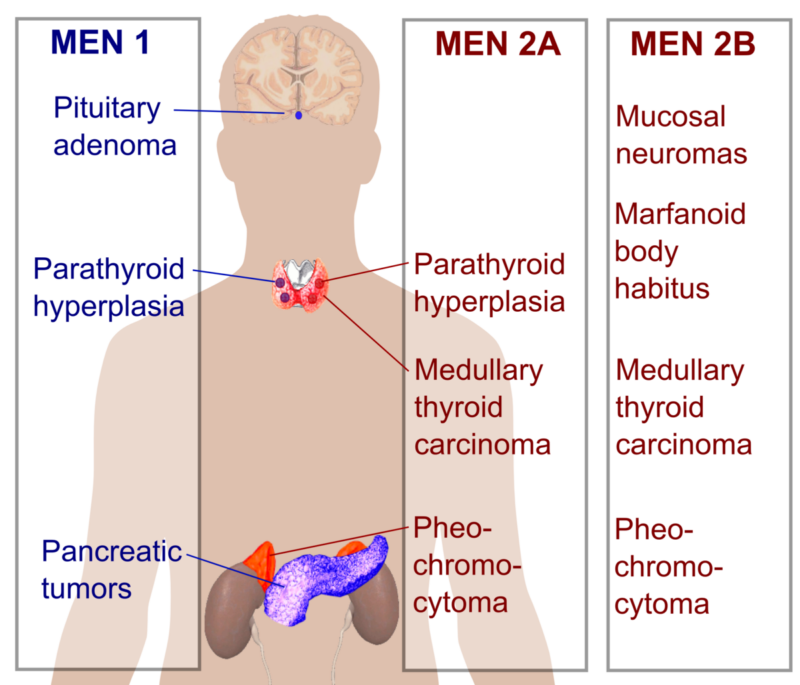 Multiple Endocrine Neoplasia Type 2A (MEN2A)