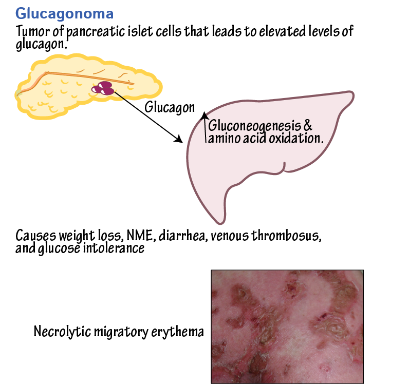 Glucagonoma