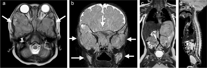 Neuroblastoma