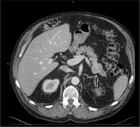 Glucagonoma