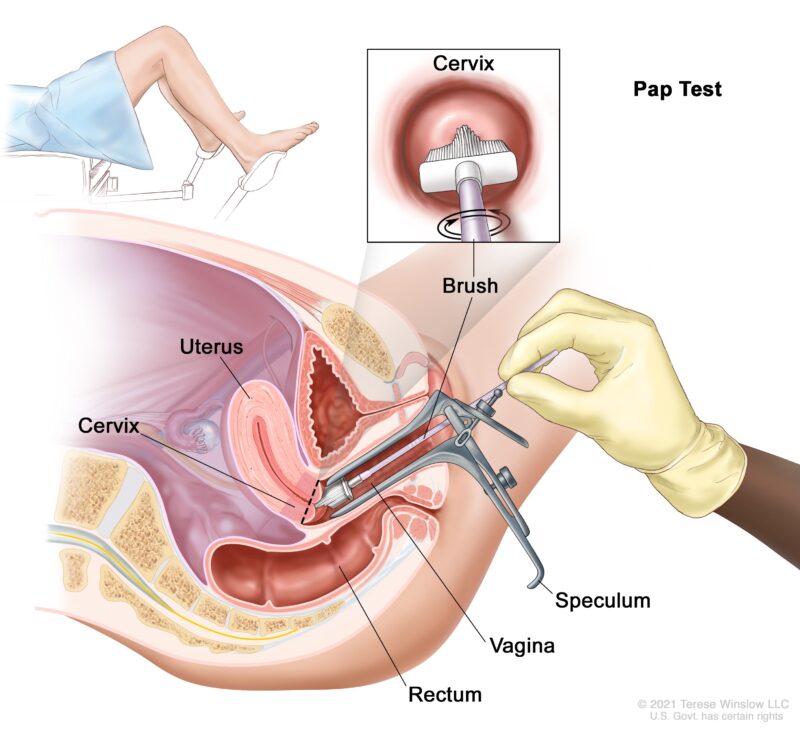 Vaginal Cancer