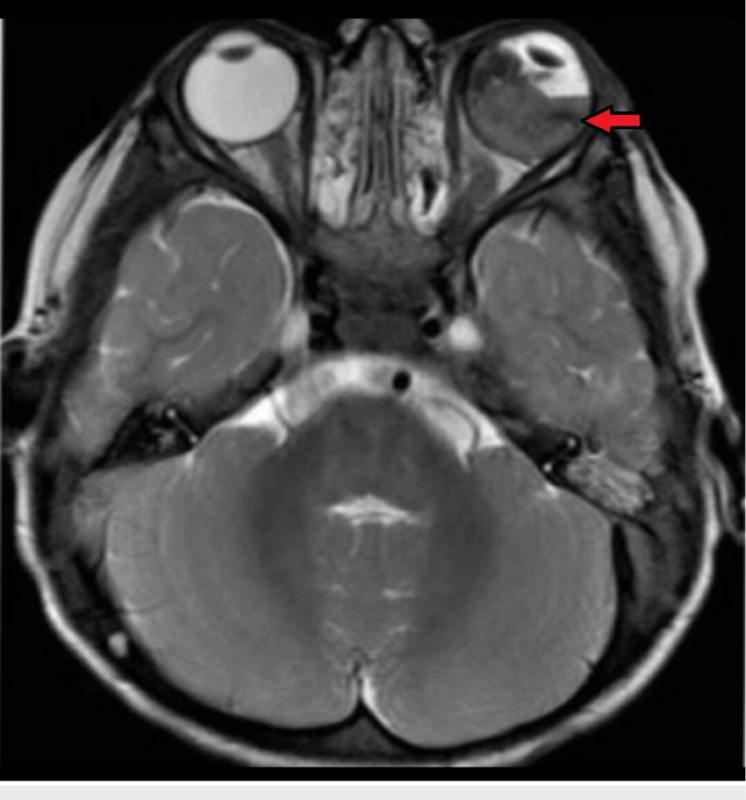 Axial T2-weighted MRI of the brain and orbit showing retinoblastoma in left eye along with retinal detachment (red arrow) Axial T2-weighted MRI of the brain and orbit showing retinoblastoma in left eye along with retinal detachment (red arrow)