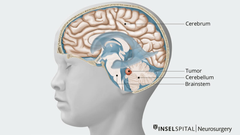 Medulloblastoma