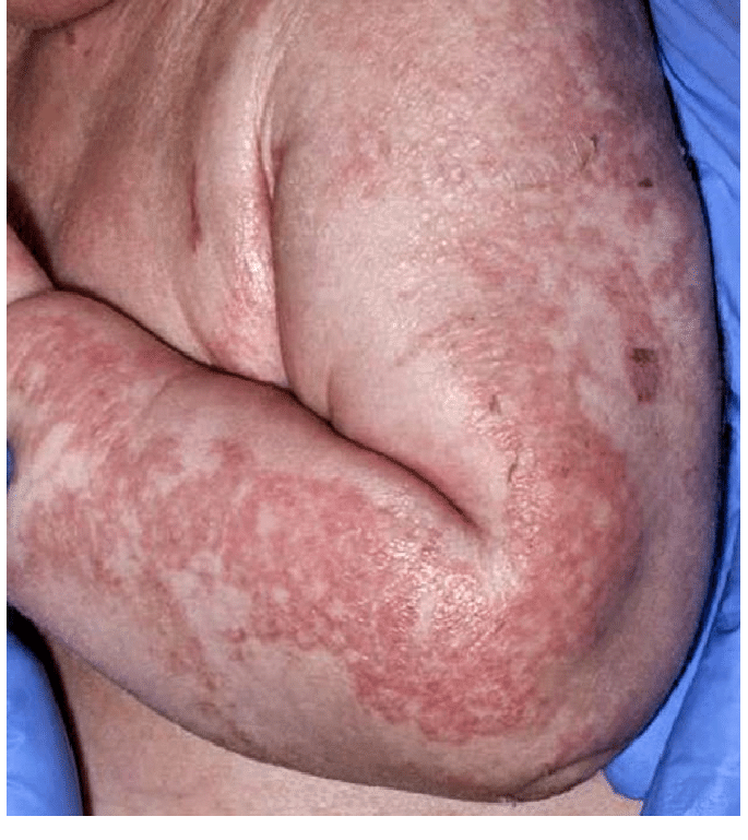 Glucagonoma