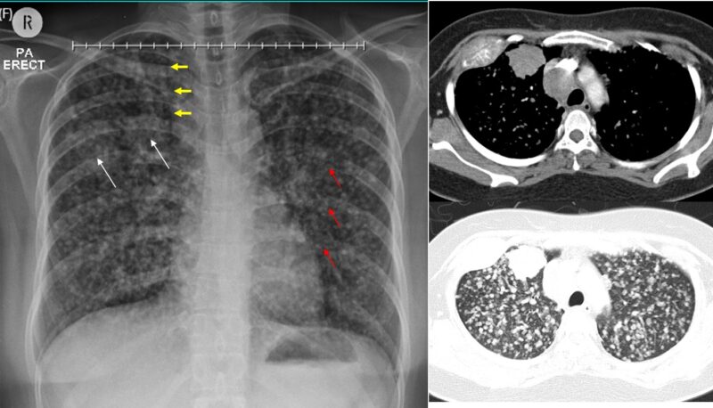 Adenocarcinoma of the lung
