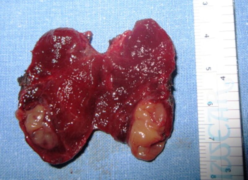 Parathyroid Cancer: What patients should know about