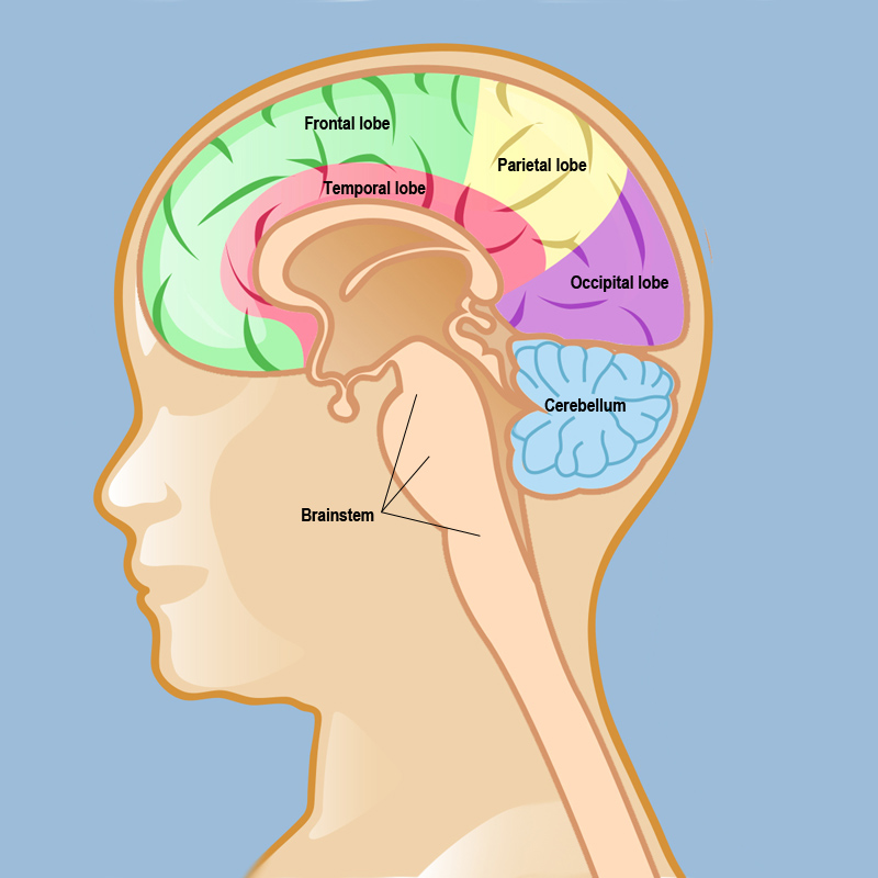 pilocytic astrocytoma