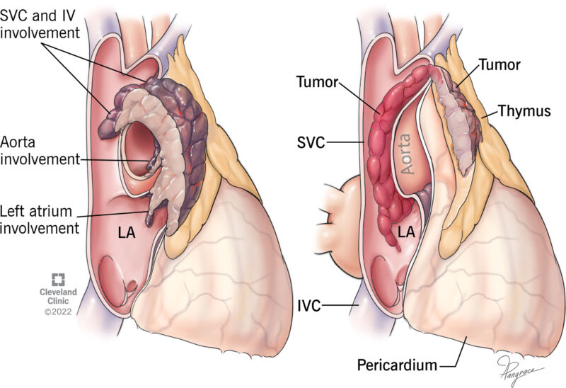 Thymoma