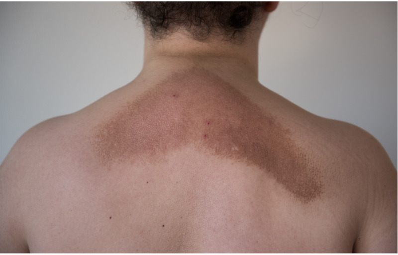 cutaneous lichen amyloidosis