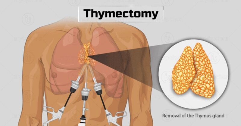 Thymoma