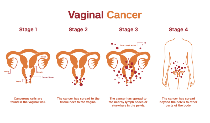 Vaginal Cancer