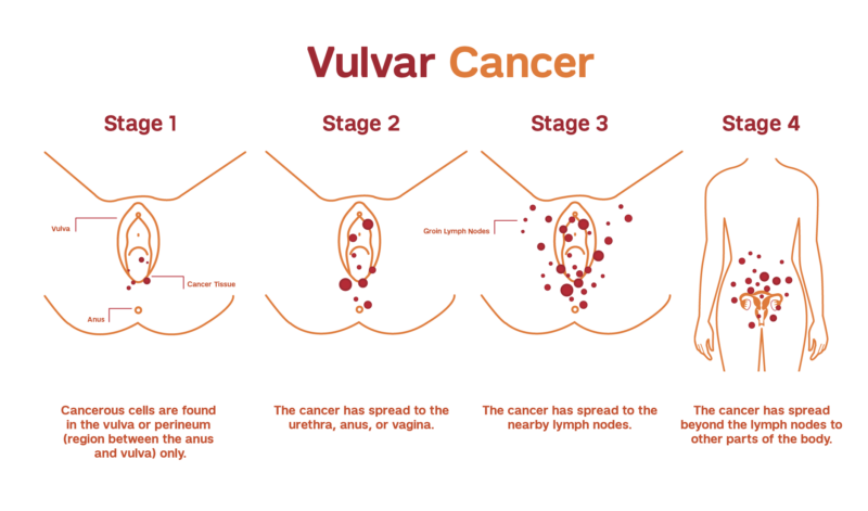 Vulvar cancer