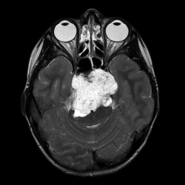 Chordoma in Children