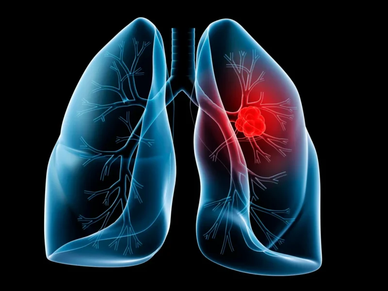 Cathy, Vicki, and Leslie show the power of ALK+ lung cancer research