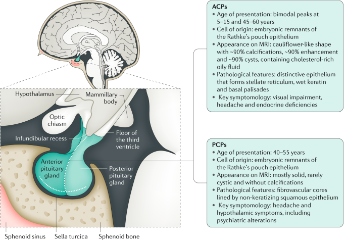 Craniopharyngioma