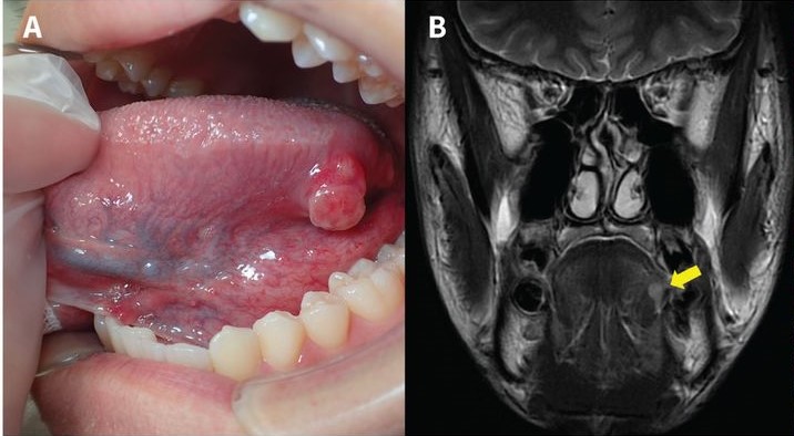 Schwannoma in Children