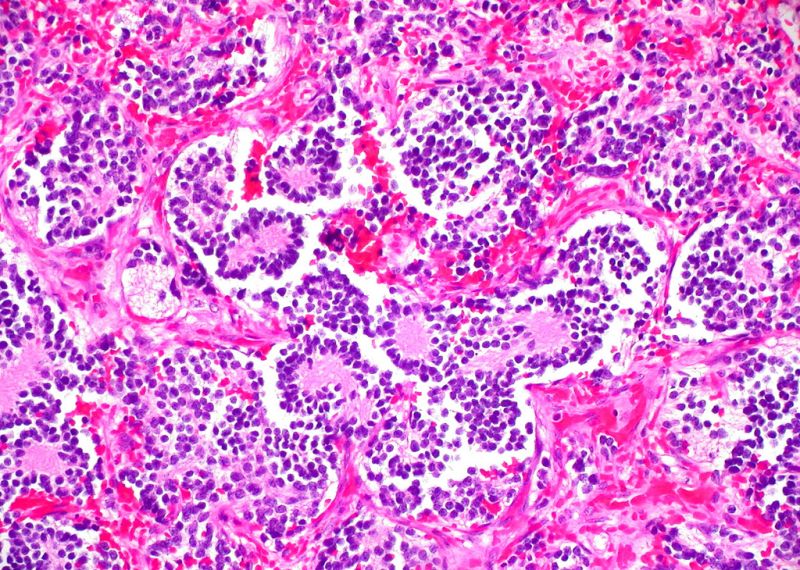 Neuroblastoma