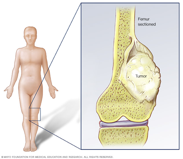 Osteosarcoma