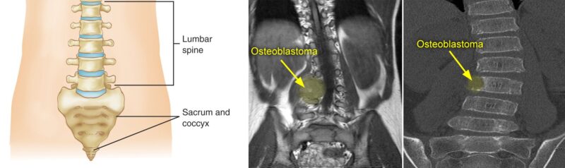 Osteoblastoma