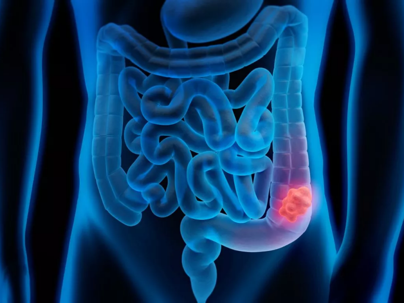 Sergio Cifuentes: Phase 2 study on neoadjuvant nivolumab + ipilimumab in dMMR colon cancer
