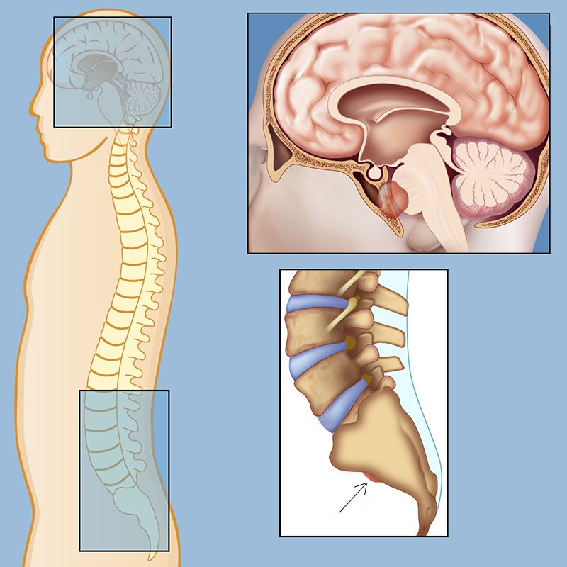 Chordoma in Adults: What patients should know about