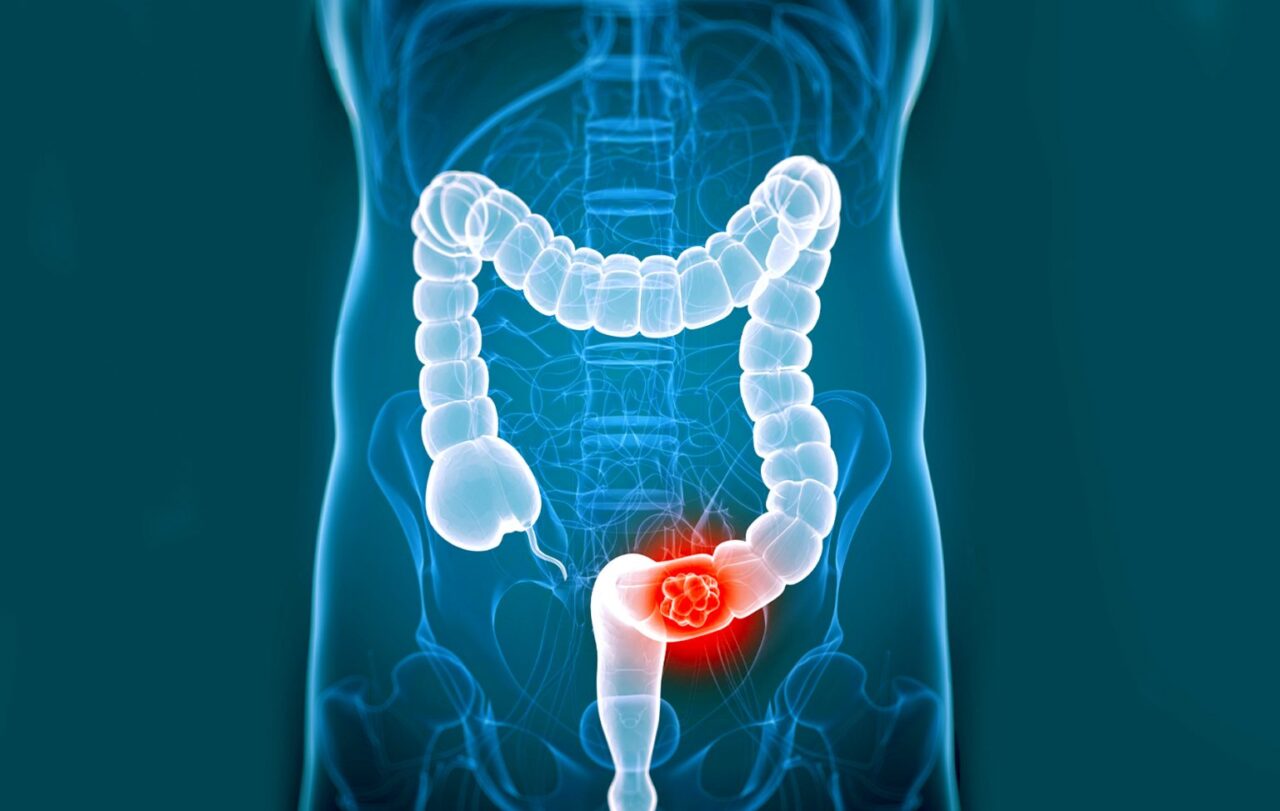 Intermittent versus continuous chemotherapy in advanced colorectal cancer