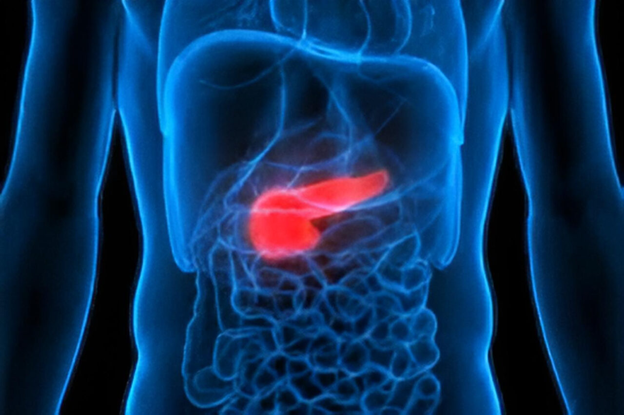 Erman Akkus: Germline mutations are common in non-familial pancreatic cancer