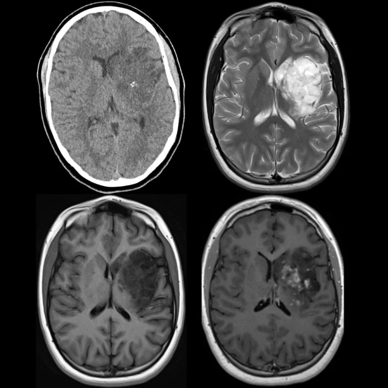 Pediatric Glioblastoma