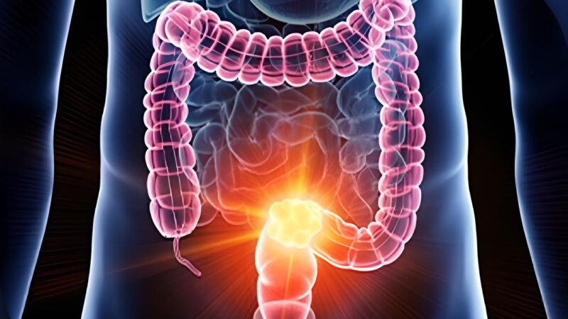 Locally Advanced Rectal Cancer is updated by ASCO