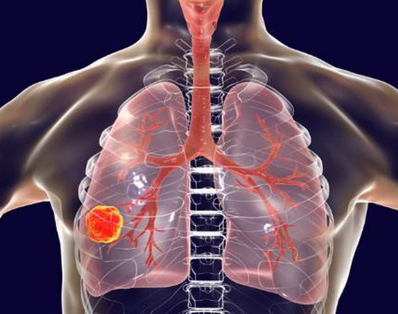 IV vs Subcutaneous amivantamab in EGFR NSCLC