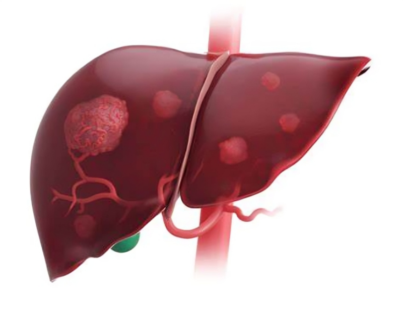 Neoadjuvant immunotherapy and SBRT in HCC