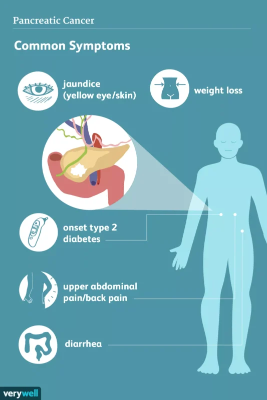 Immunotherapy for Pancreatic Cancer: Challenges and Opportunities