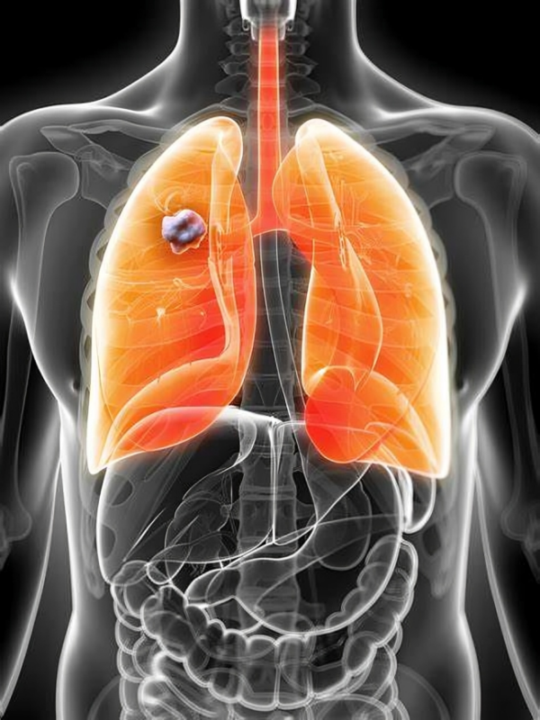 Jonathan Spicer: Incredible pace of development for patients with resectable NSCLC