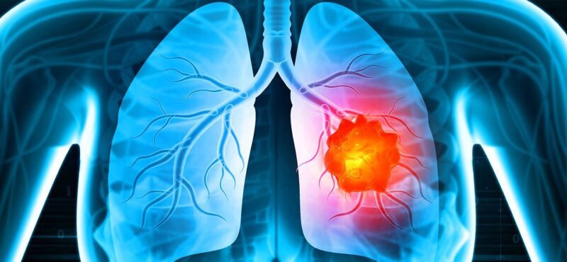 Ivan R. Gonzalez: Lung cancer effectiveness of immunotherapy in early stage