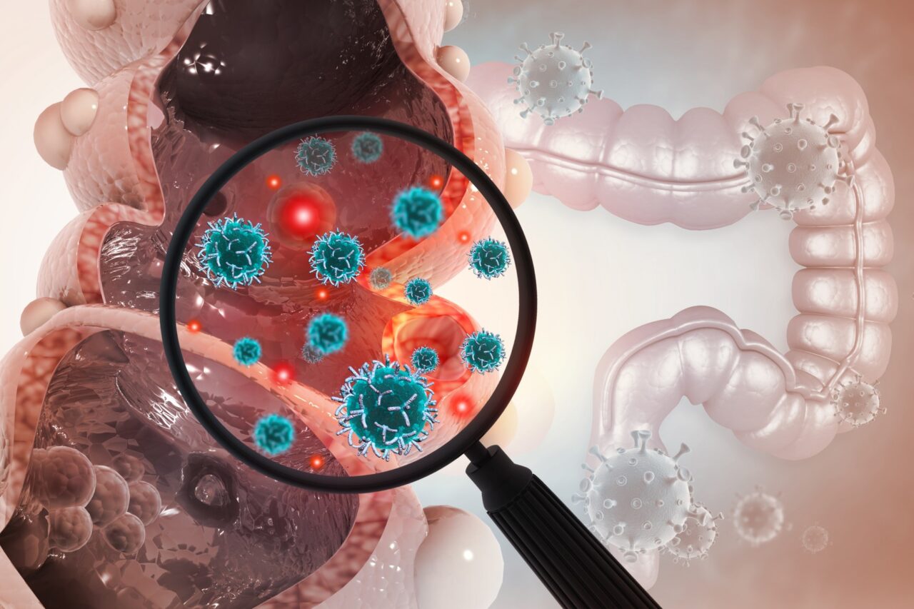 MRD testing using a ctDNA to Predict Recurrence of Metastatic Colorectal Cancer