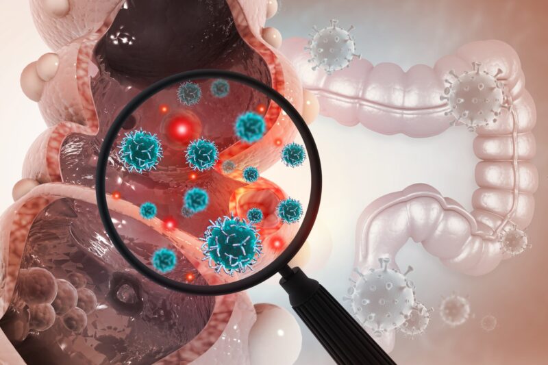 MRD testing using a ctDNA to Predict Recurrence of Metastatic Colorectal Cancer