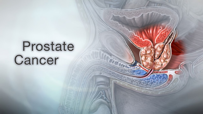 Jess Scott: What is the optimal exercise dose in prostate cancer?