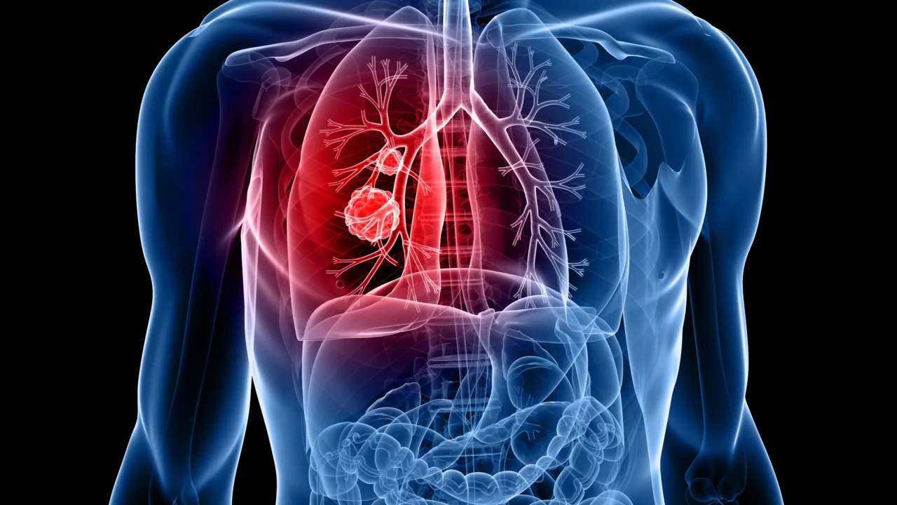 Lung cancer accounts for 1 in every 5 cancer deaths globally – IASLC