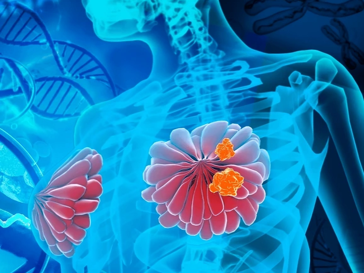 Yuksel Urun: Breast cancer risk factors strongest evidence