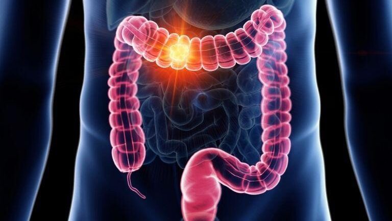 ESMO Updates Colon Cancer Guidelines to Include Structured Physical Activity