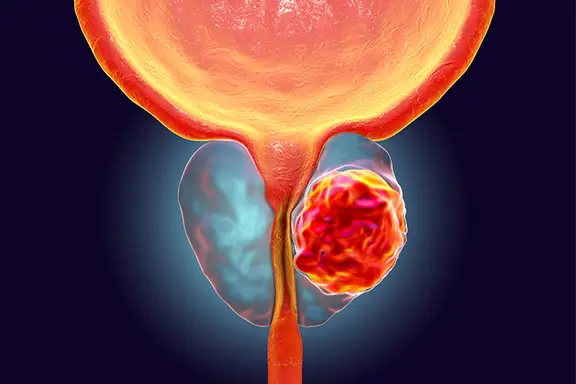 Toni Choueiri: Positive topline results for darolutamide in men with mHSPC