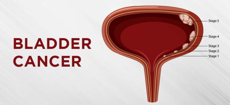 Personalised radiotherapy shows promise in Bladder Cancer – The Institute of Cancer Research