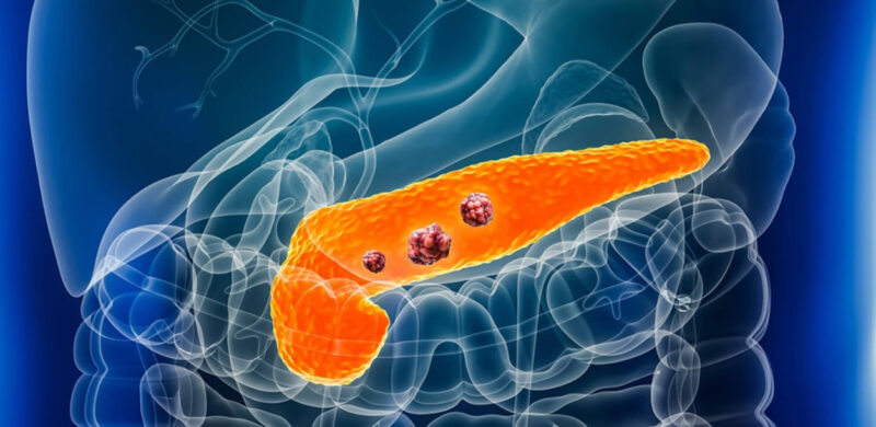 Stromal Interleukin-33 Directs the Pancreatic Microenvironment to Promote Tumor Growth