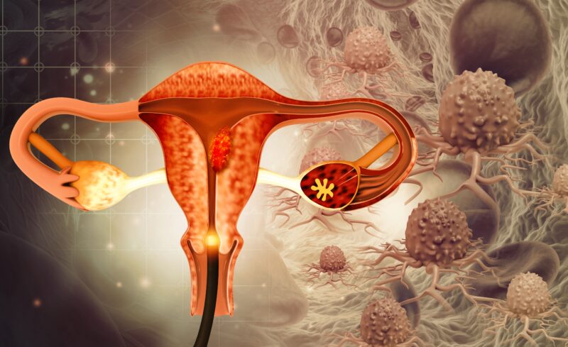 Delving into the topic of early detection for ovarian cancer with Sarah DeFeo and Gillian Hanley